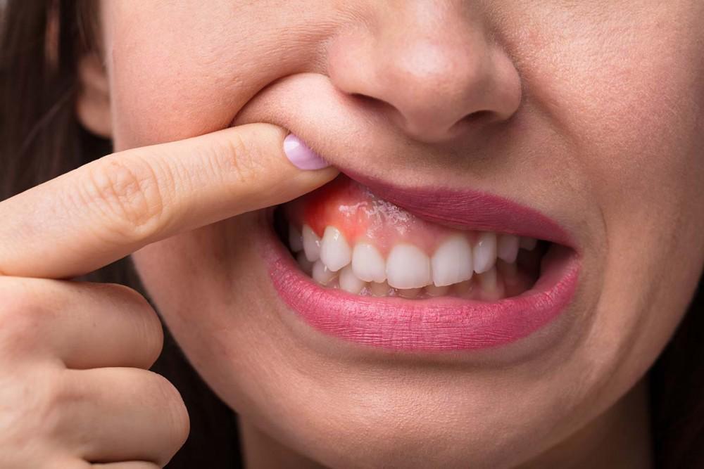 Early Gum Disease: Can Gingivitis Be Reversed?