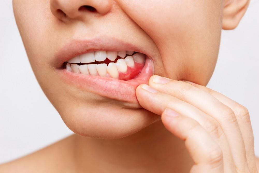 Got Gum Disease? Deep Cleaning Can Help