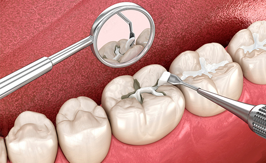 Fillings - Nobel Dentistry