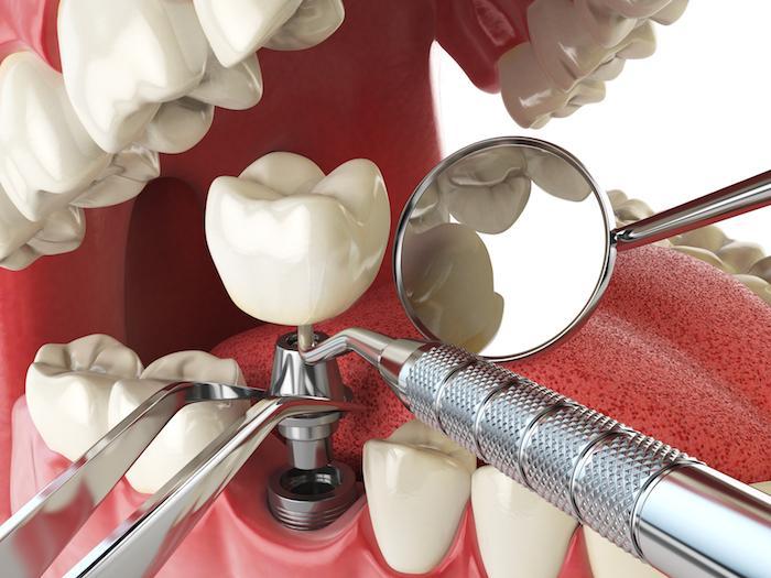 Bridge vs. Implant: How to Decide Which Is Best for You