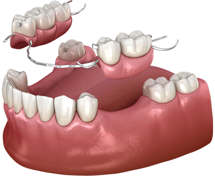 Dr. Nobel- Partial Dentures